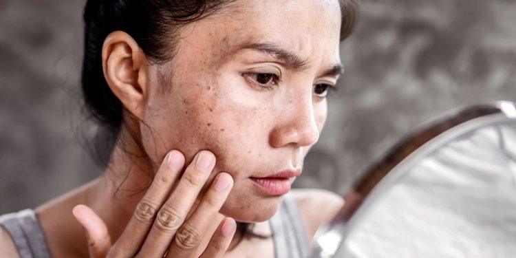 Hyperpigmentation 101: The Key Causes and Treatments