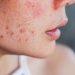 Summer Acne SOS – Banish Breakouts